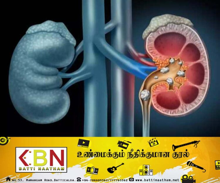 நாட்டில் சிறுநீரக நோயாளர்களின் எண்ணிக்கை அதிகரிப்பு!
