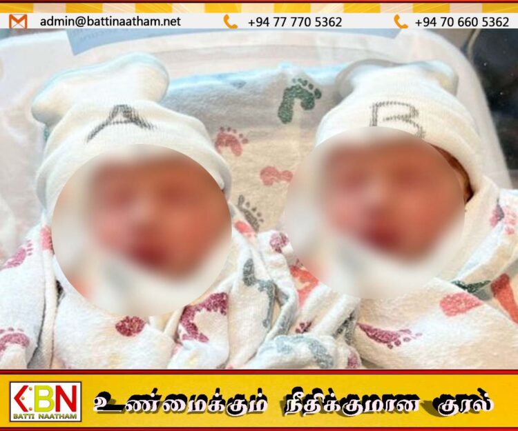 இலங்கையில் ஒட்டிப்பிறந்த குழந்தைகள்
