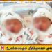 இலங்கையில் ஒட்டிப்பிறந்த குழந்தைகள்