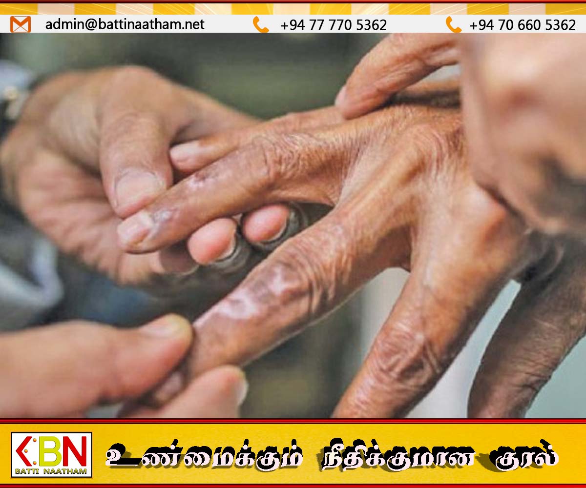 இலங்கையில் தொழுநோய் மீண்டும் அதிகரிப்பு; சிறுவர்கள் பாதிப்பு