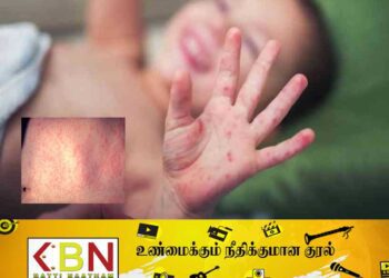 உடம்பில் சிவப்பு புள்ளிகள்; குழந்தைகளுக்கு பரவும் நோய்!