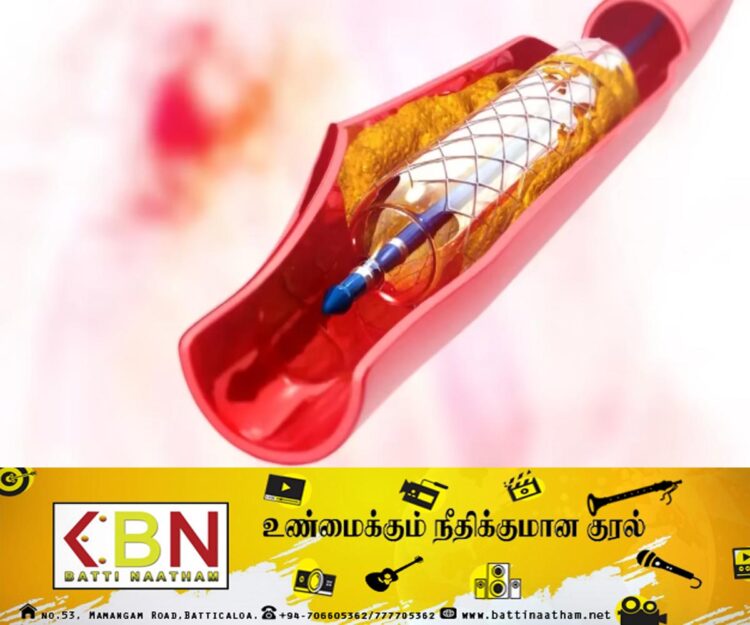 ஸ்டென்ட் குழாய்களுக்கு தட்டுப்பாடு; இருதய நோயாளிகளுக்கு பாதிப்பு!
