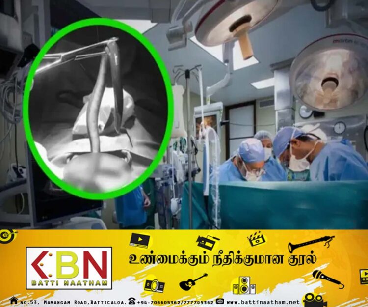வயிற்றுக்குள் வாழ்ந்த விலாங்கு மீன்; அறுவை சிகிச்சையில் அதிர்ச்சியடைந்த மருத்துவர்கள்!
