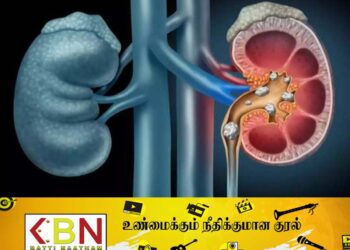 நாட்டில் சிறுநீரக நோயாளர்களின் எண்ணிக்கை அதிகரிப்பு!
