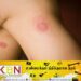 நாட்டில் இளைஞர்களிடையே பரவி வரும் தோல்நோய்!