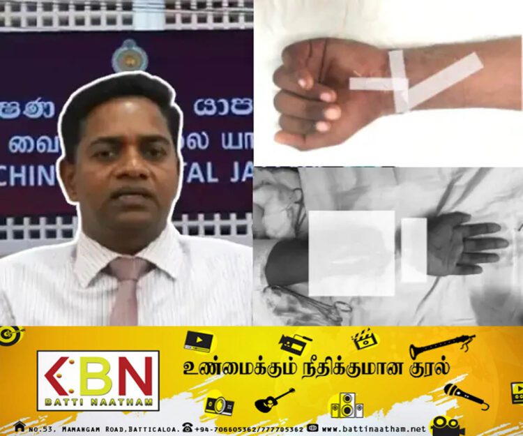 இரண்டு துண்டுகளாகக்கப்பட்ட கையை வெற்றிகரமாக பொருத்திய யாழ் போதனா வைத்தியசாலை வைத்தியர்கள்!