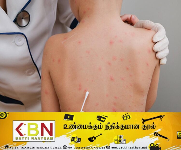 அதிகரிக்கும் வெப்ப நிலையால் தோல் நோய்கள் ஏற்படும் அபாயம்; வைத்திய நிபுணர்கள் எச்சரிக்கை!