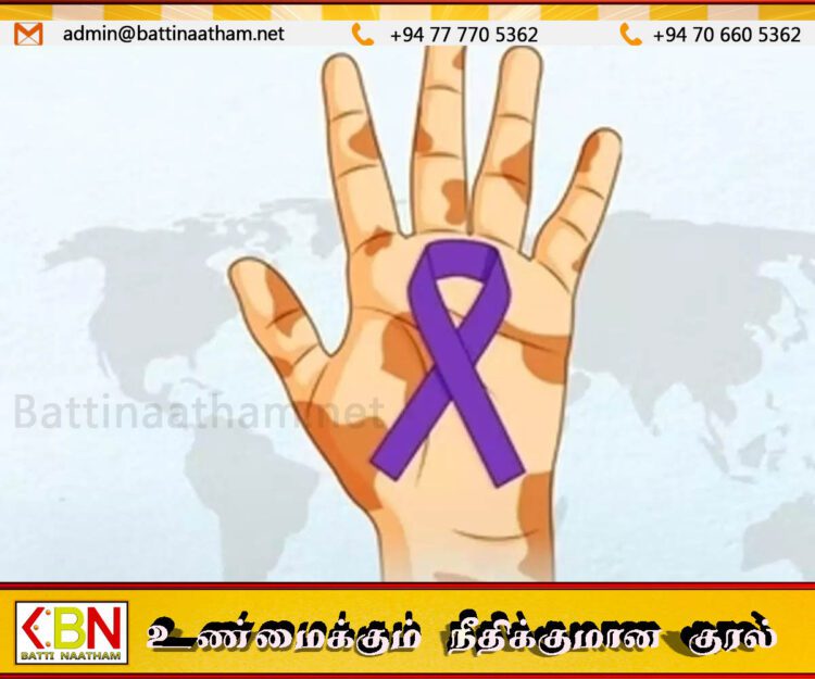 இலங்கை மக்களை அச்சுறுத்தும் தொழுநோய்; விடுக்கப்பட்டுள்ள எச்சரிக்கை
