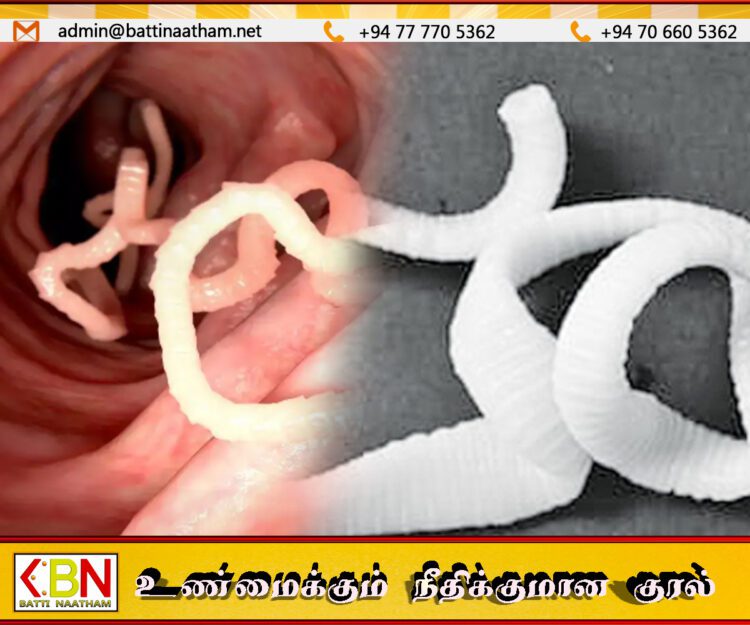 இலங்கையில் முதல் முறையாக சிறுவனின் வயிற்றில் மிக நீளமான நாடாப்புழு கண்டுபிடிப்பு