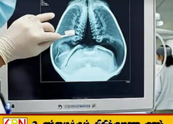 வயிற்றுக்குள் பல் துலக்கியுடன் 52 ஆண்டுகள் வாழ்ந்த நபர்