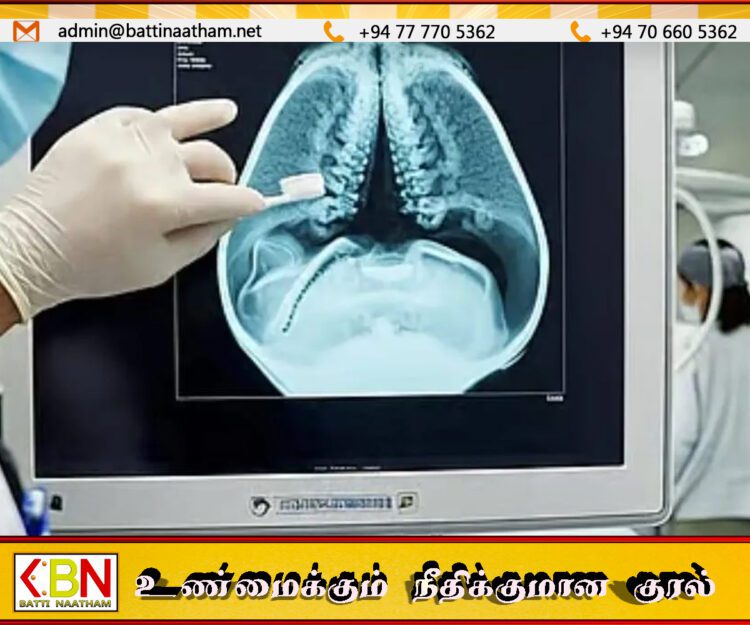 வயிற்றுக்குள் பல் துலக்கியுடன் 52 ஆண்டுகள் வாழ்ந்த நபர்