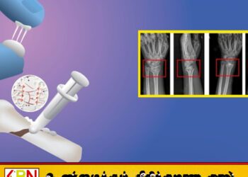 சீனாவில் உடைந்த எலும்புகளை 2–3 நிமிடத்தில் ஒட்டும் புதிய ‘போன் க்ளூ’ கண்டுபிடிப்பு