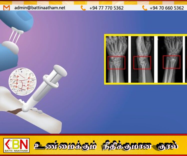 சீனாவில் உடைந்த எலும்புகளை 2–3 நிமிடத்தில் ஒட்டும் புதிய ‘போன் க்ளூ’ கண்டுபிடிப்பு