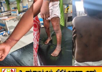 5 வயது சிறுமிக்கு சூடு வைத்து அடித்து சித்திரவதை; மட்டு கொக்கட்டிச்சோலை பொலிஸார் விசாரணை