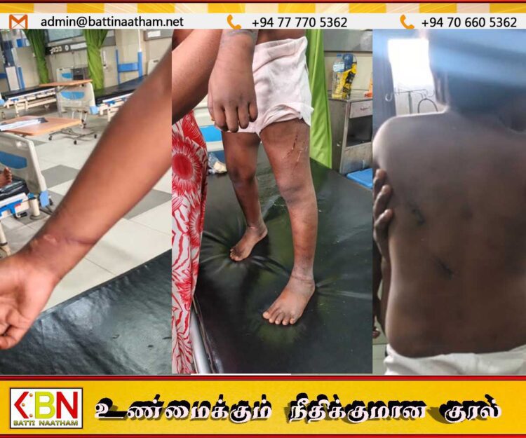 5 வயது சிறுமிக்கு சூடு வைத்து அடித்து சித்திரவதை; மட்டு கொக்கட்டிச்சோலை பொலிஸார் விசாரணை