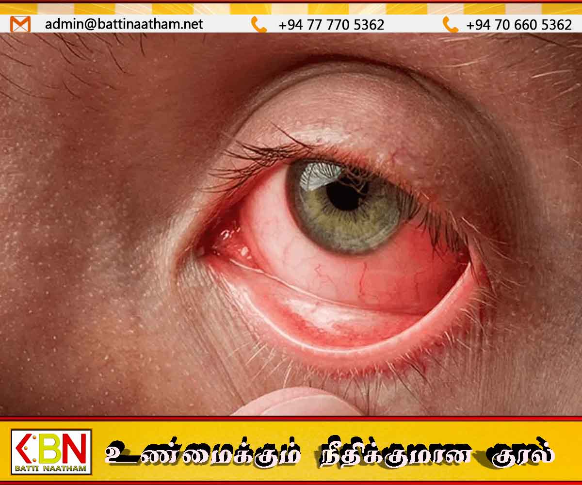 வெள்ளத்தால் பாதிக்கப்பட்டவர்களுக்கு வெண்படல நோய் பரவல் அதிகரிப்பு