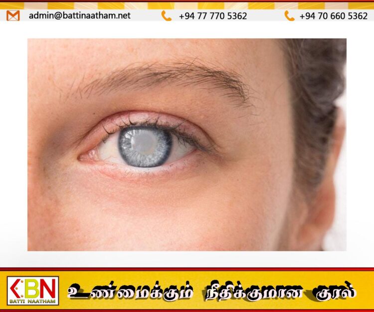உலகில் 94 மில்லியனுக்கும் மேற்பட்ட மக்கள் கண்புரையால் அவதியுறுகின்றனர்