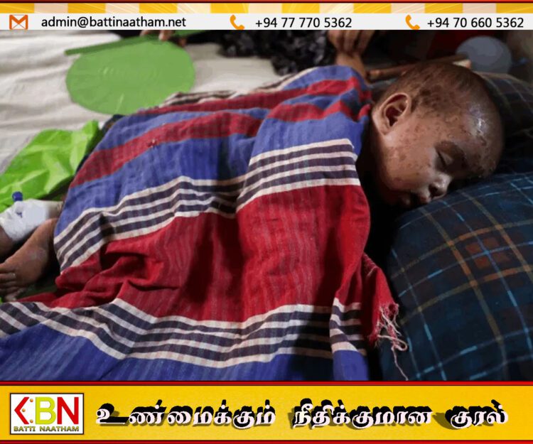 பங்களாதேஷில் தட்டம்மை நோய்; 259 பேர் உயிரிழப்பு!