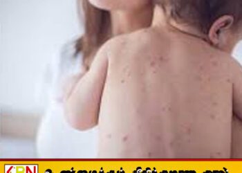 பங்களாதேஷில் தட்டம்மை நோயினால் 100 குழந்தைகள் உயிரிழப்பு!