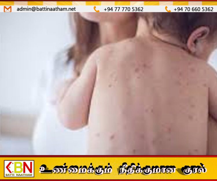 பங்களாதேஷில் தட்டம்மை நோயினால் 100 குழந்தைகள் உயிரிழப்பு!