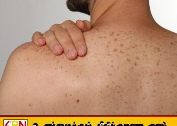 சூரிய ஒளியால் புற்றுநோய் அபாயம்; பொதுமக்களுக்கு விசேட மருத்துவ எச்சரிக்கை!