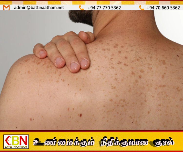 சூரிய ஒளியால் புற்றுநோய் அபாயம்; பொதுமக்களுக்கு விசேட மருத்துவ எச்சரிக்கை!