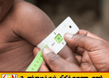 இலங்கையில் மாணவர்களில் ஊட்டச்சத்து குறைபாடு அதிகரிப்பு; ஐந்தில் ஒருவர் பாதிப்பு