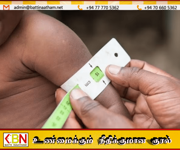 இலங்கையில் மாணவர்களில் ஊட்டச்சத்து குறைபாடு அதிகரிப்பு; ஐந்தில் ஒருவர் பாதிப்பு