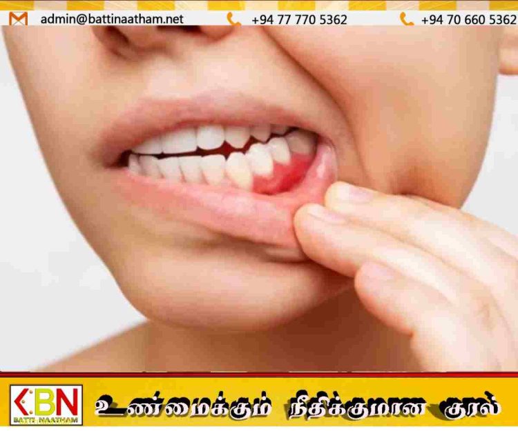 வாய் புற்றுநோயால் தினமும் மூவர் உயிரிழப்பு; சுகாதார எச்சரிக்கை!