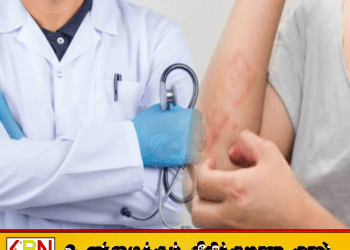 டெங்குவுடன் அதிகரிக்கும் தோல் நோய்கள்; சுகாதாரத் துறை எச்சரிக்கை!