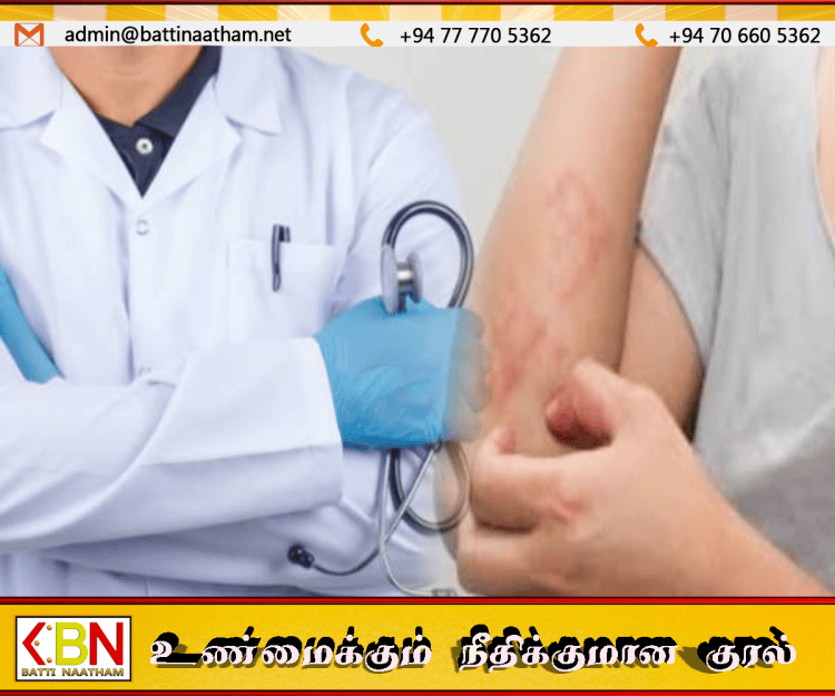 டெங்குவுடன் அதிகரிக்கும் தோல் நோய்கள்; சுகாதாரத் துறை எச்சரிக்கை!