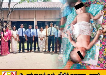 பேராதனையில் இணைந்திருந்த இரட்டையர்கள் வெற்றிகரமாகப் பிரிப்பு; உலகின் முதல் சிறுநீரக மாற்று சாதனை!