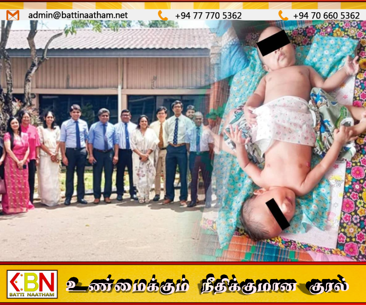 பேராதனையில் இணைந்திருந்த இரட்டையர்கள் வெற்றிகரமாகப் பிரிப்பு; உலகின் முதல் சிறுநீரக மாற்று சாதனை!