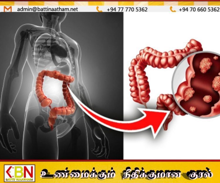 இளைஞர்களிடையே அதிகரிக்கும் குடல் நோய்கள்; உணவுப் பழக்கமே முக்கிய காரணம்!