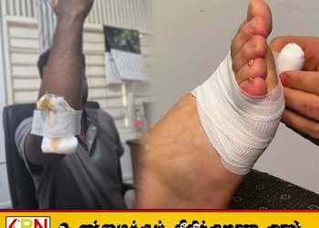 இலங்கை வைத்தியசாலைகளில் பேண்டேஜிற்கு தட்டுப்பாடு