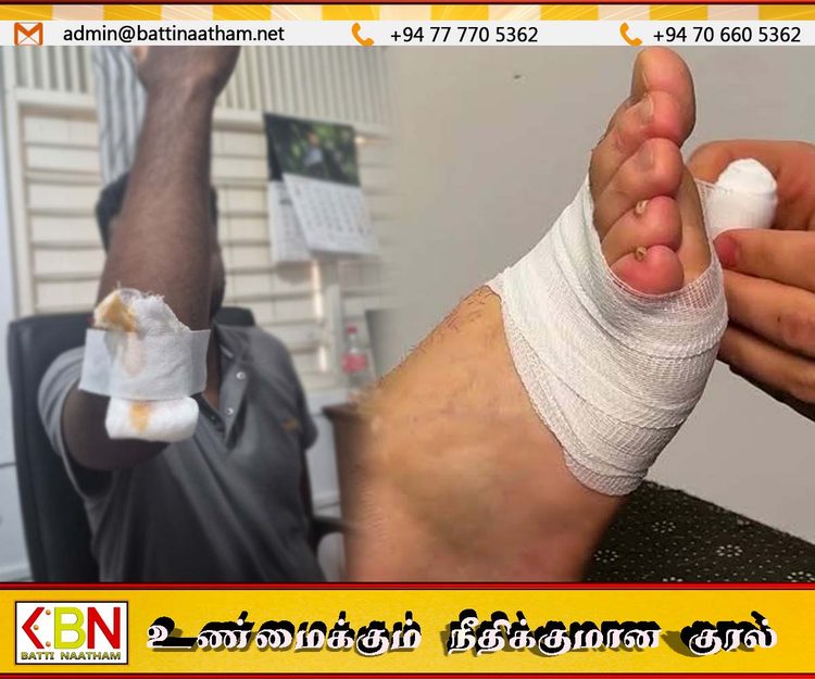 இலங்கை வைத்தியசாலைகளில் பேண்டேஜிற்கு தட்டுப்பாடு