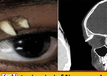 சிறுவனின் கண் இமைக்கு மேல் வளர்ந்த 2 பற்கள்; மருத்துவர்களையே வியக்க வைத்த அரிய சம்பவம்!