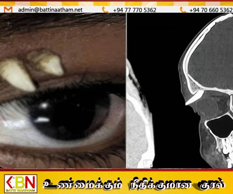 சிறுவனின் கண் இமைக்கு மேல் வளர்ந்த 2 பற்கள்; மருத்துவர்களையே வியக்க வைத்த அரிய சம்பவம்!