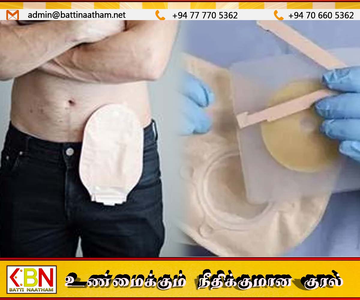 இலங்கை மருத்துவமனைகளில் கொலோஸ்டமி பைகளுக்குத் தட்டுப்பாடு!